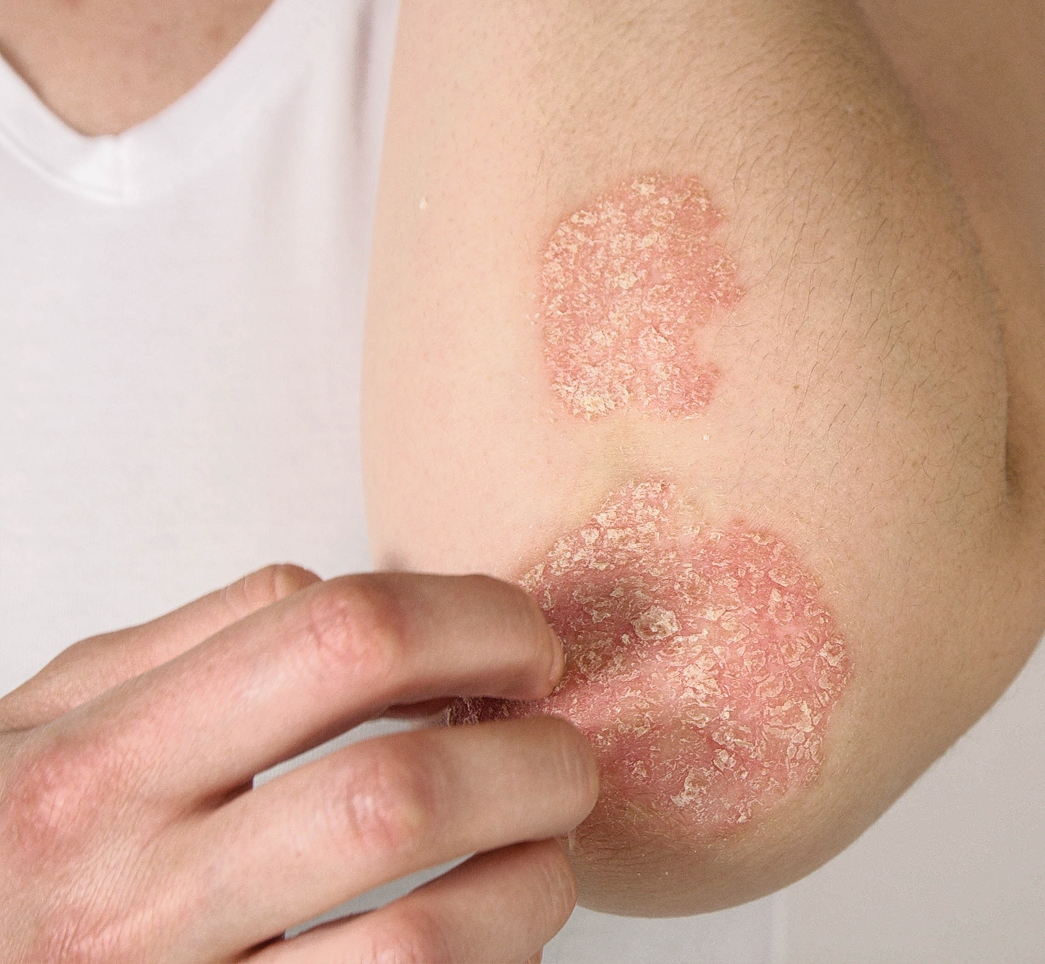 Eczema & Psoriasis